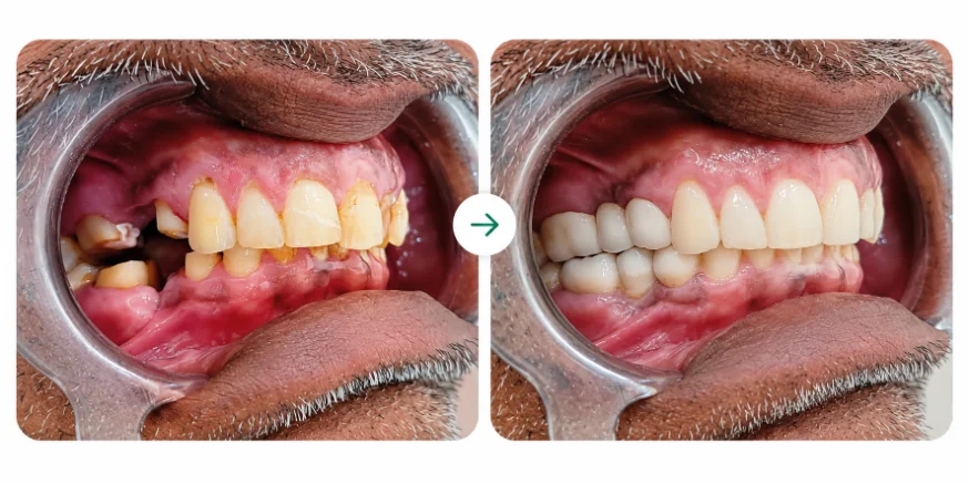 Before and after crown and bridge treatment at Varahi Dental Care