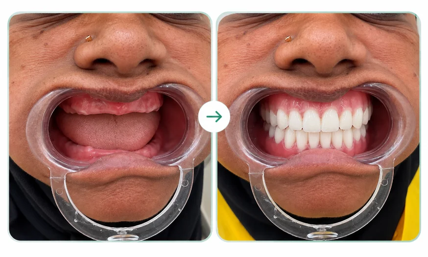 Before and after dental restoration case, Varahi Dental Care Karimnagar