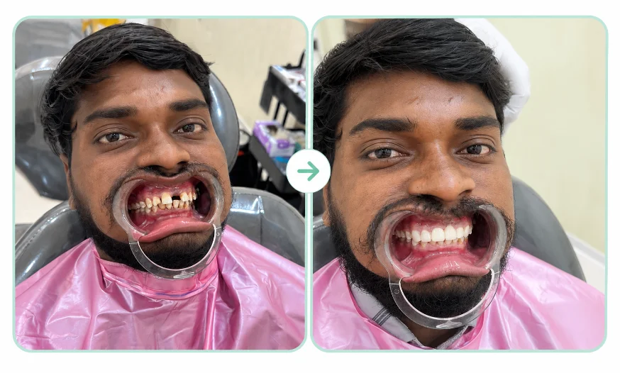 Before and after full-mouth rehabilitation at Varahi Dental Care
